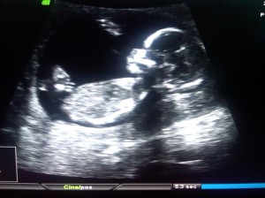 Ultrasound -- baby girl